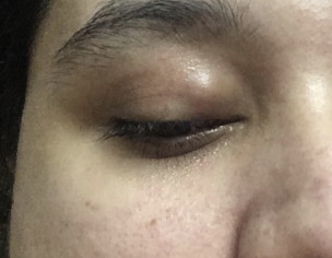 Eye Chalazion &amp; Weakness