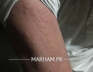 Skin Rashes 