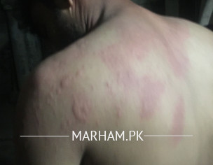Skin Rashes 