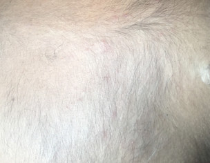 Skin Lesions 