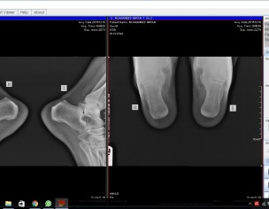 PLANTAR FACITICHS