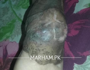 Microsurgery, Free Flap Surgery,plastic Surgery 