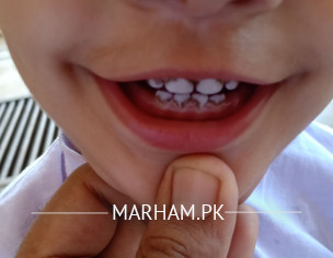 Teeth Problem