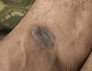 Dark Hard Skin