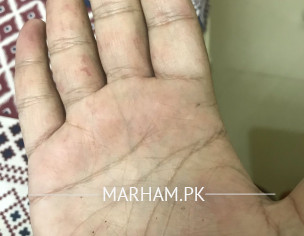 Clots On Hands