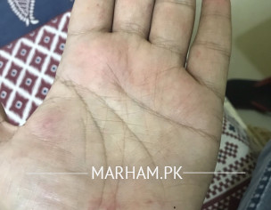 Clots On Hands