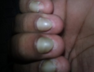 NAILS