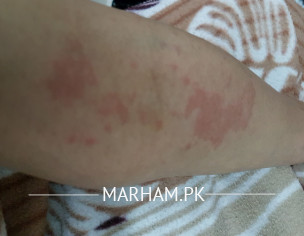 Acute Urticaria
