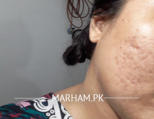 Pimples