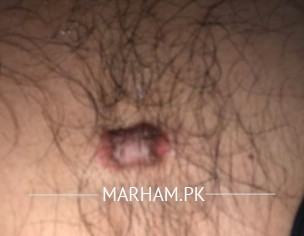 Mole On Chest 