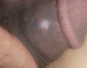 Sexually Transmitted Disease