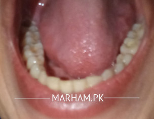 Gums Teeth Problems