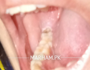 Gums Problems