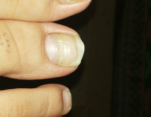 Toe Nail Crack