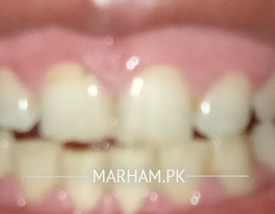 Gums Problems