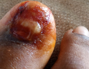 Toe Nail Breakage