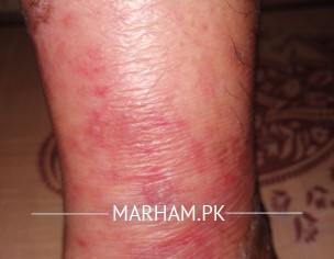 Cellulitis