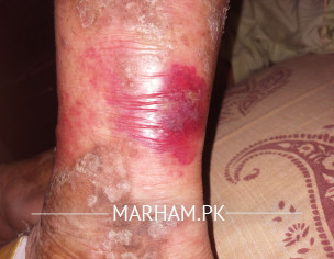 Cellulitis