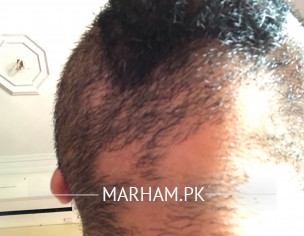 Balding In The Beard Area