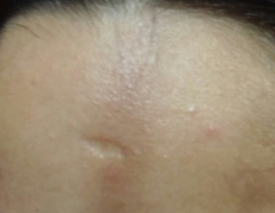 Linear Morphea
