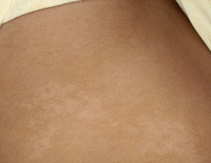Skin Patch