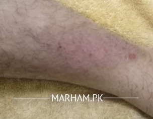 Elergy On Leg 