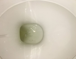 Bubbles In Urine