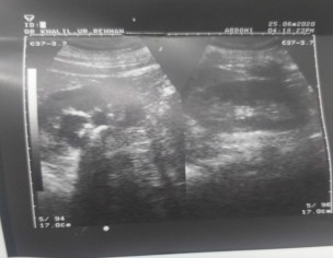 Kidney Problem