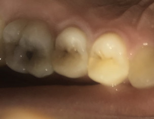 Carries In Molar 