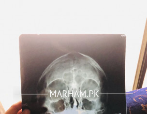 Deviated Septum 
