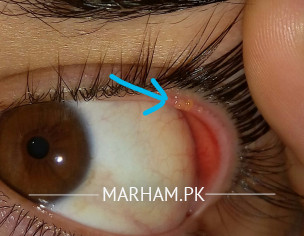 EYE..