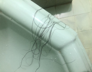 Extreme Hairfall