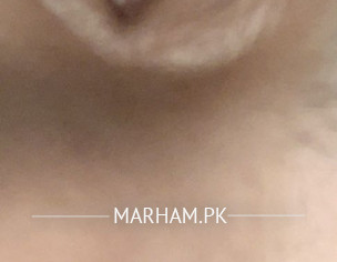 Eye Problems 