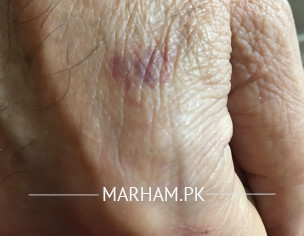 Patch On Hand Near Thumb