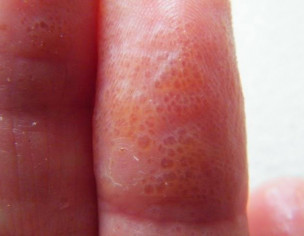 Skin Disease 