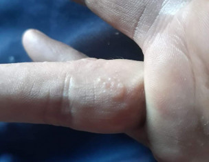 Skin Disease 