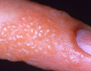 Skin Disease 