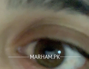 Eye Problems 