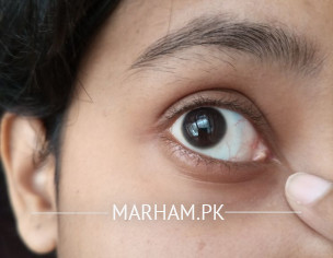 Eye Problem