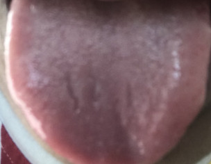 Tounge Cuts