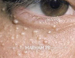 Eye Problem