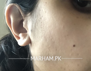 Pitted Skin 