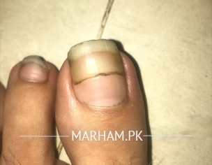 Toenail Discolouration 