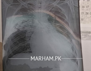 Heart Issue