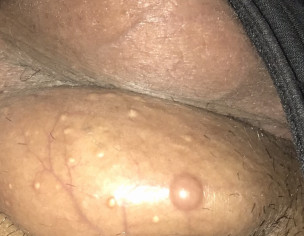 Testicular Problem