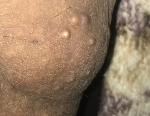 Testicular Problem