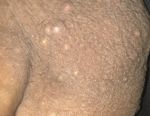 Testicular Problem