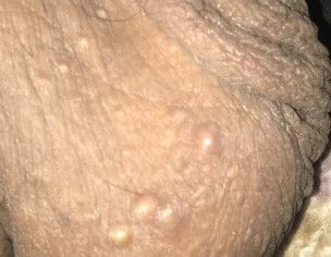 Testicular Problem