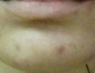 Acne Issue