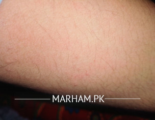 Allergy Or Scabies